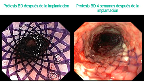 Endoprótesis BD